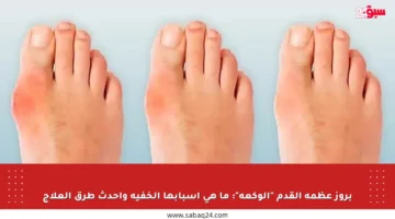 بروز عظمة القدم “الوكعة”: ما هي أسبابها الخفية وأحدث طرق العلاج